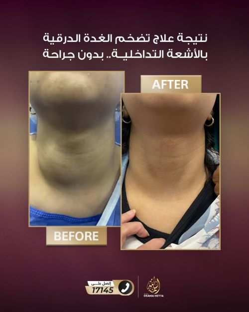 علاج عقد الغدة الدرقية بالأشعة التداخلية
